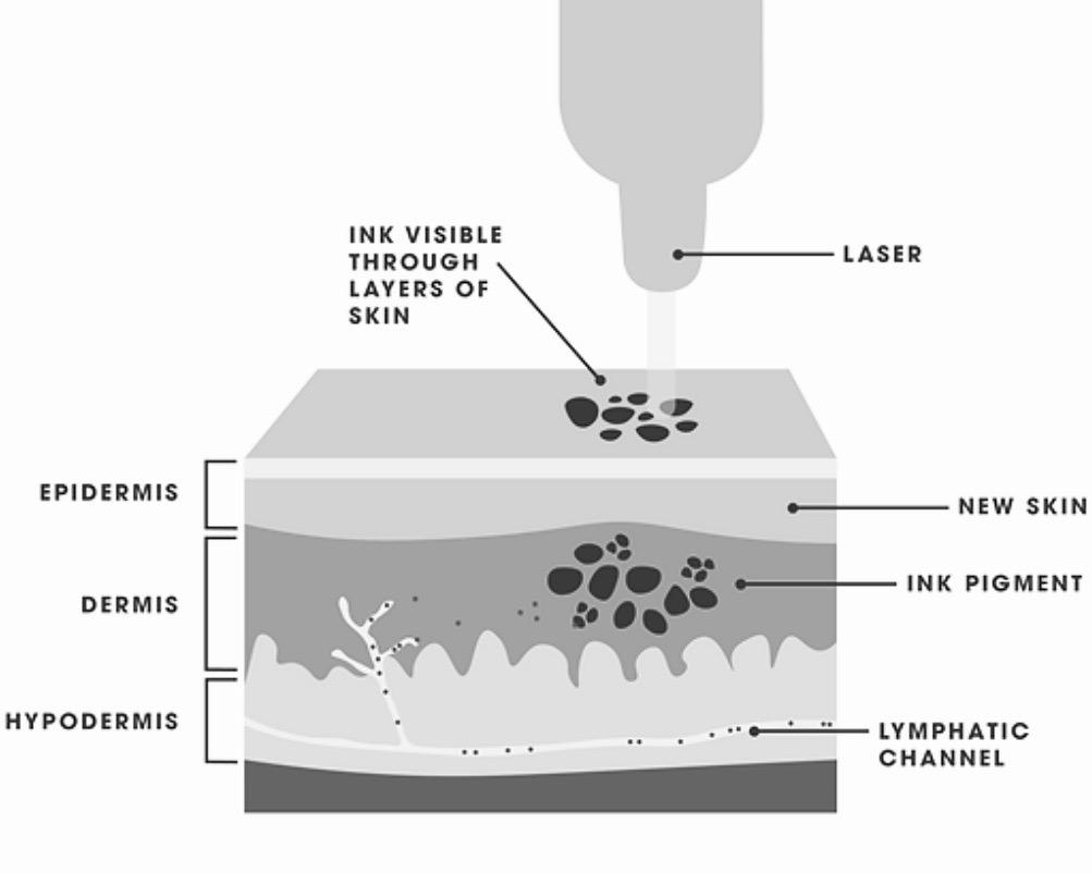 A diagram showing the process of a skin treatment.