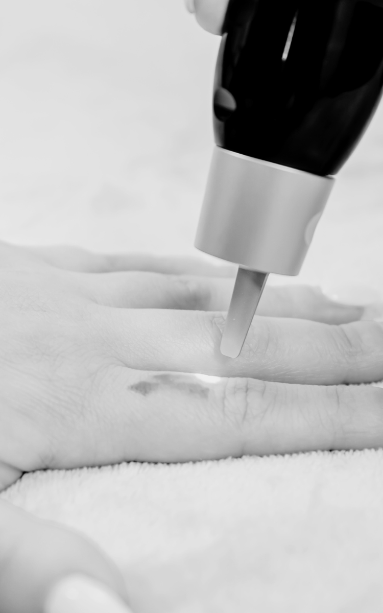 A woman is using a nail polish remover on her finger for tattoo removal in Kent.